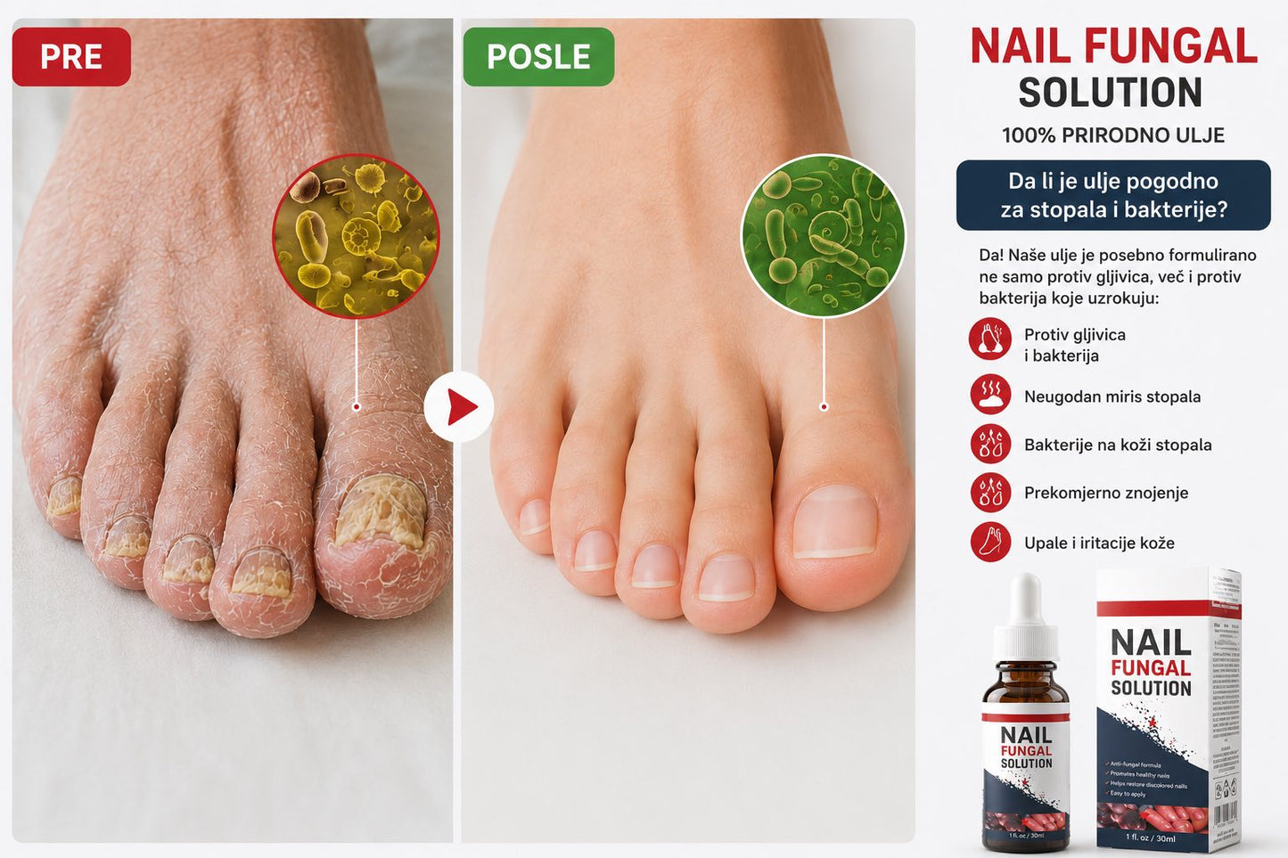 NAIL FUNGAL SOLUTION – prije i poslije primjene