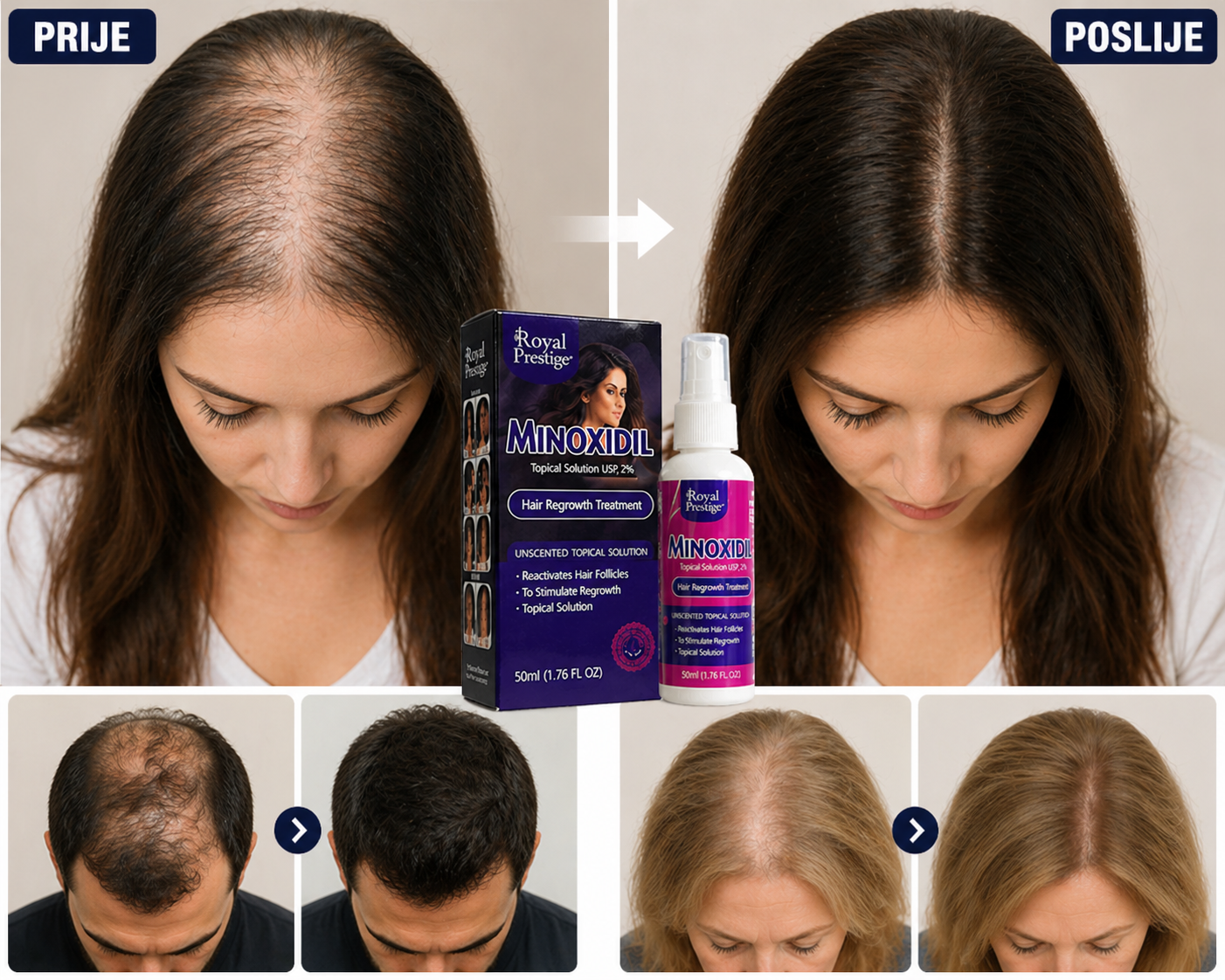 Minoxidil Sprej za Rast Kose – Povratite gustinu i samopouzdanje