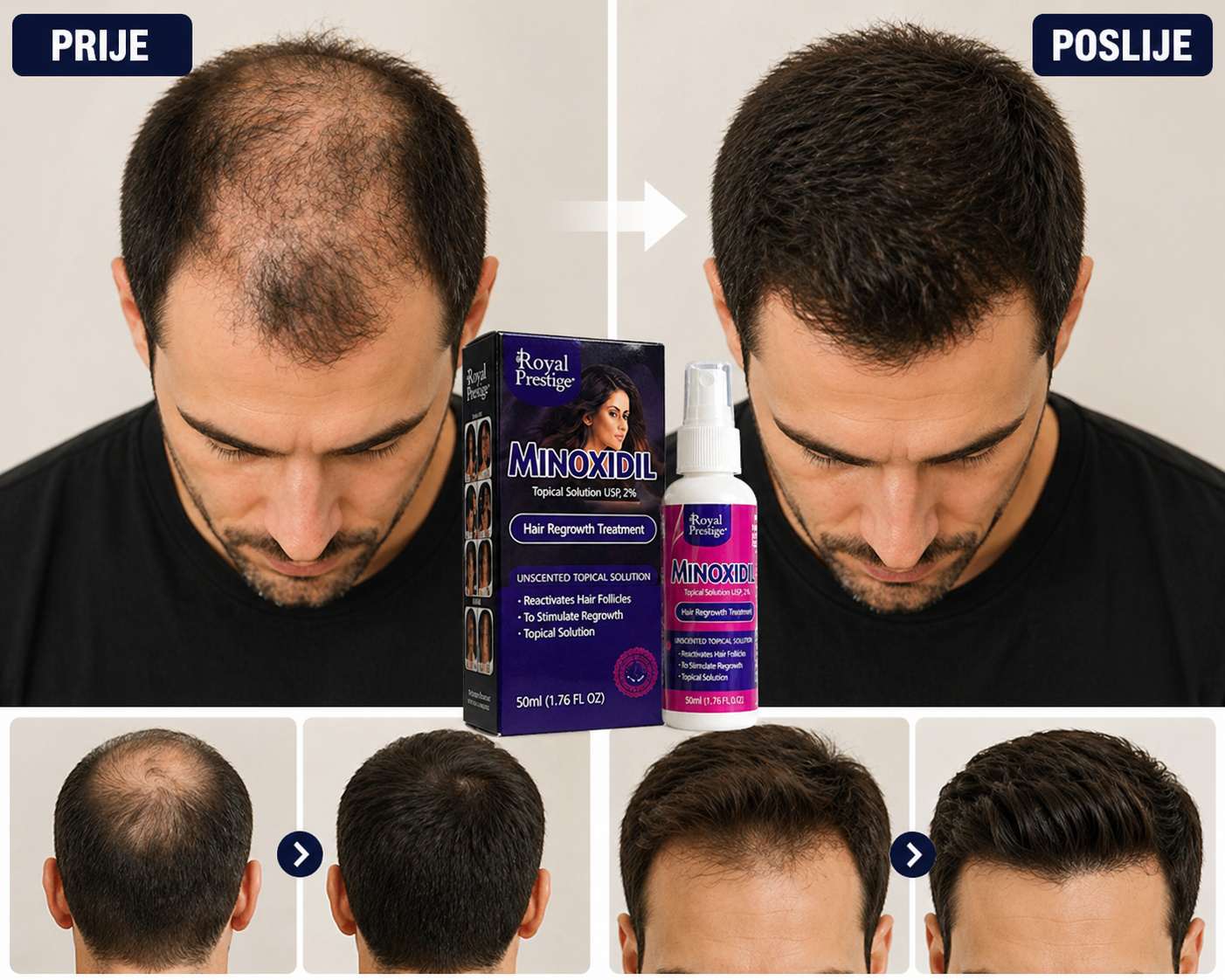 Minoxidil Sprej za Rast Kose – Povratite gustinu i samopouzdanje